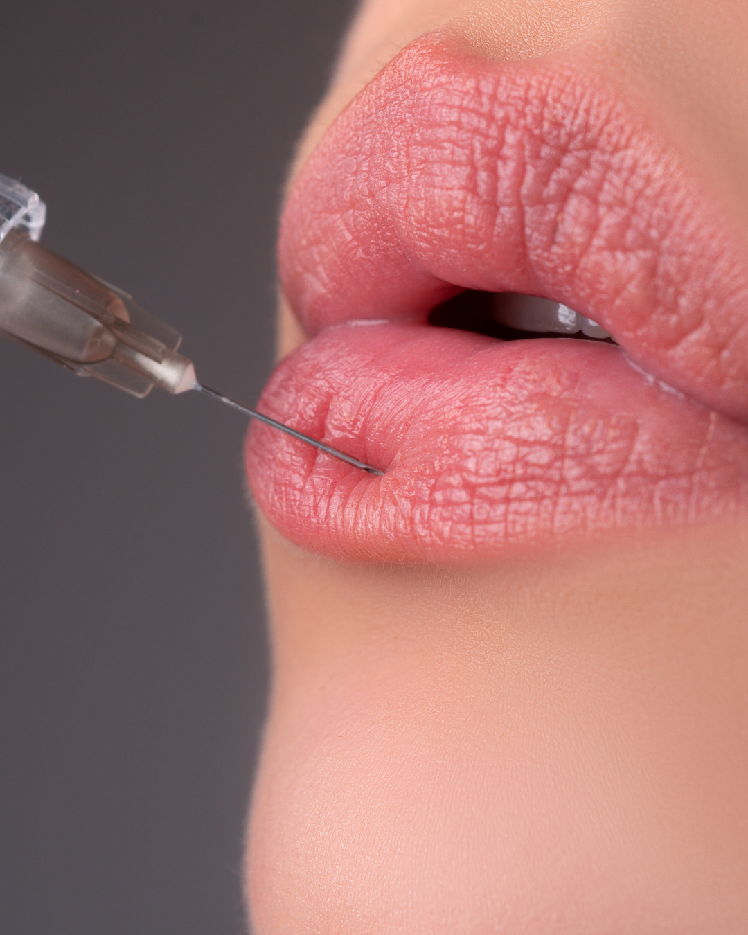 Preenchimento Labial
